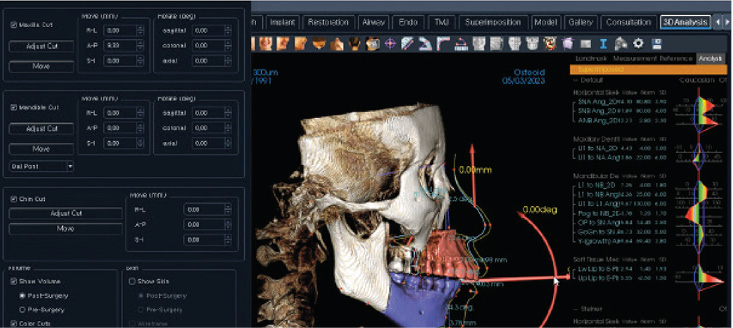 Cirugía 3D-Módulo OMS